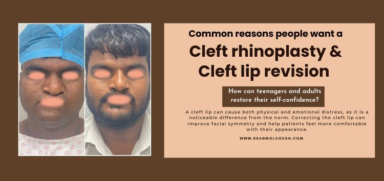 Can cleft rhinoplasty and cleft lip revision help adults and teenagers regain their confidence