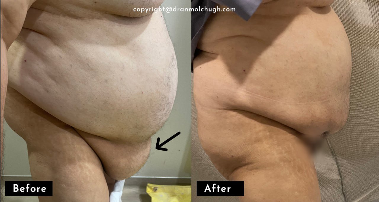 Panniculectomy Surgery Results