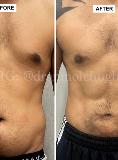 High-Definition Liposuction