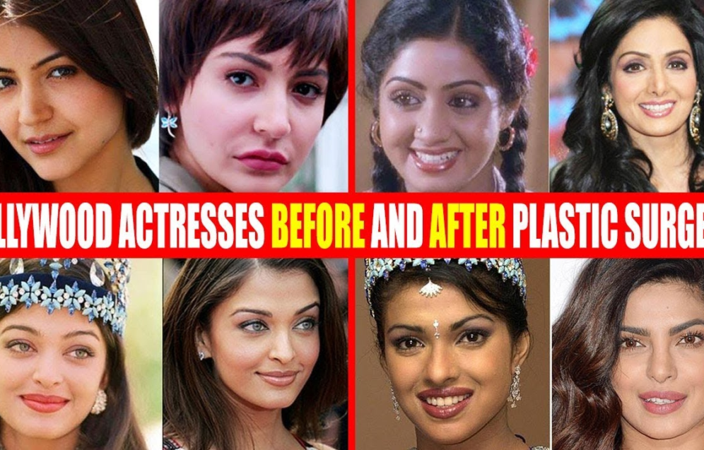 Celebrity rhinoplasty trends and nose job transformations