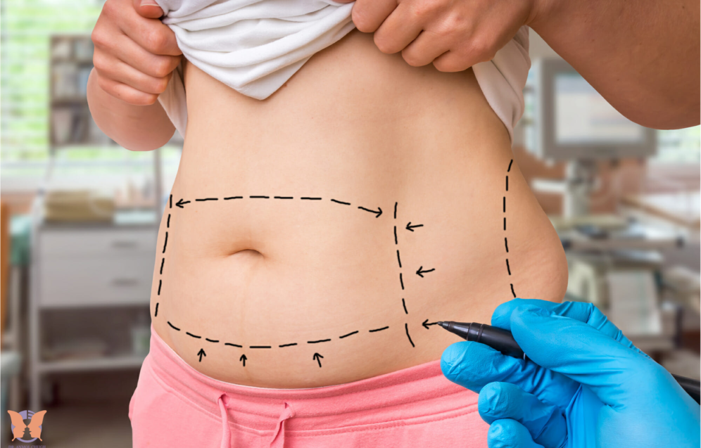 Tips for smooth recovery and healing after tummy tuck surgery