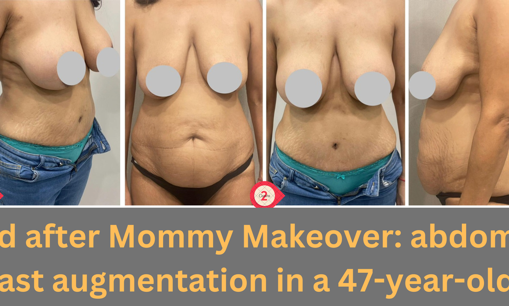 Before and after Mommy Makeover: abdominoplasty and breast augmentation in a 47-year-old female