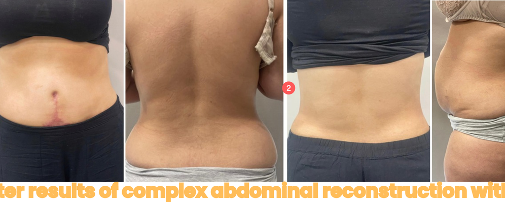 Before and after results of complex abdominal reconstruction with tummy tuck