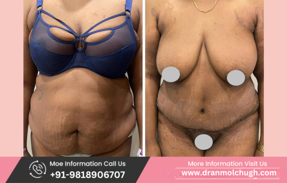 Before and after results of tummy tuck for a 50-year-old high BMI patient