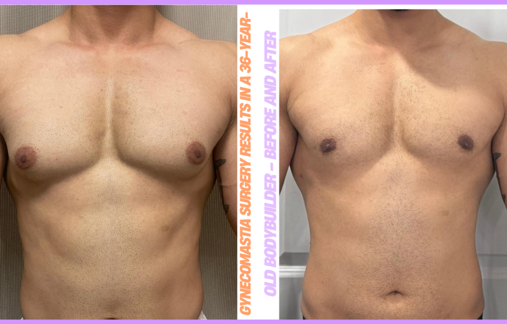 Gynecomastia surgery results in a 36-year-old bodybuilder – before and after