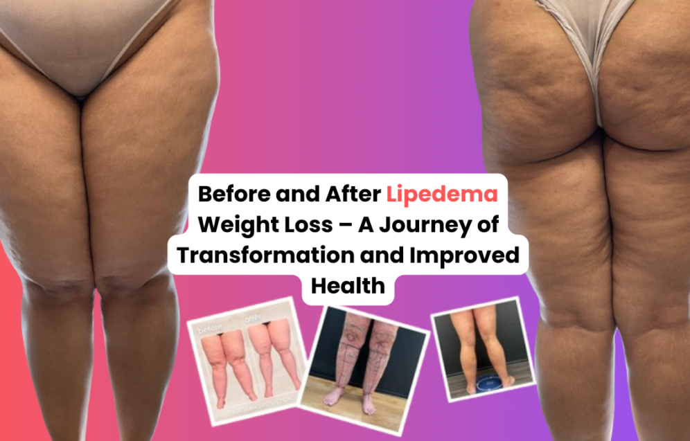 Before and after lipedema weight loss – A journey of transformation and improved health Before and after lipedema weight loss – A journey of transformation and improved health