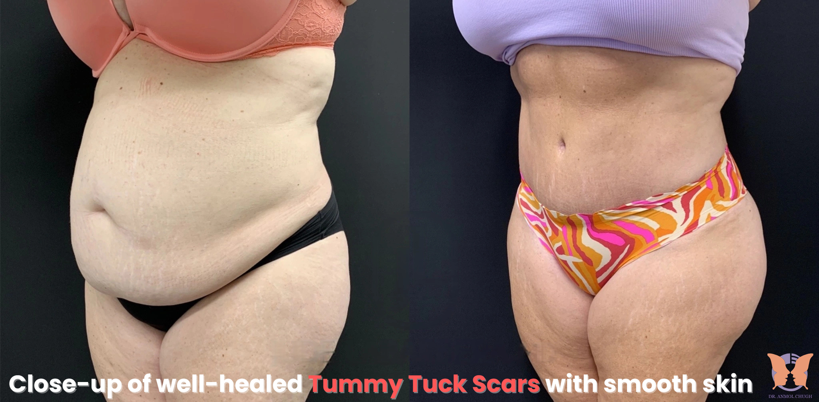 Close-up of well-healed tummy tuck scars with smooth skin