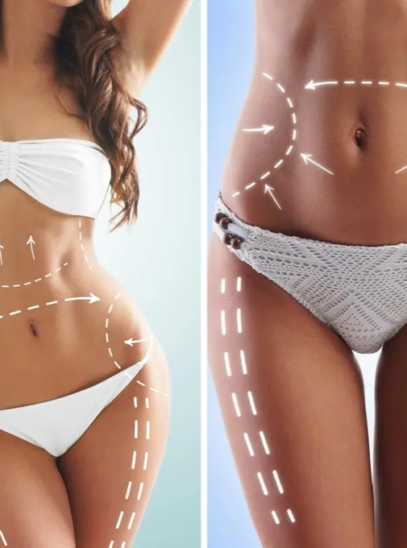 Illustration of how liposuction works to remove excess fat from the body