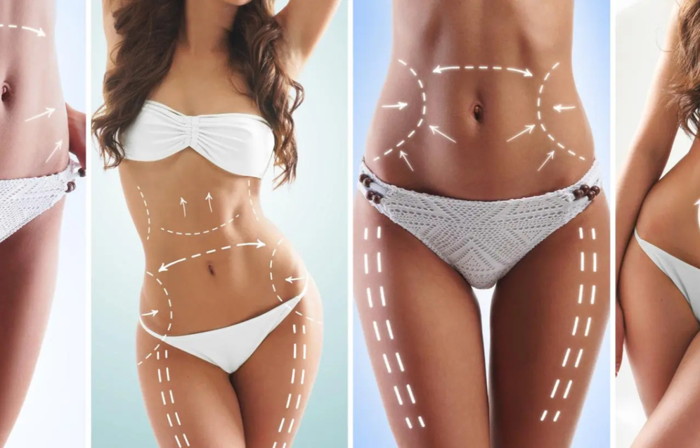 Illustration of how liposuction works to remove excess fat from the body Illustration of how liposuction works to remove excess fat from the body