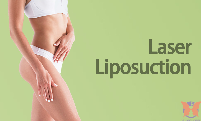 Laser liposuction for stomach – Effective fat removal and body contouring Laser liposuction for stomach – Effective fat removal and body contouring
