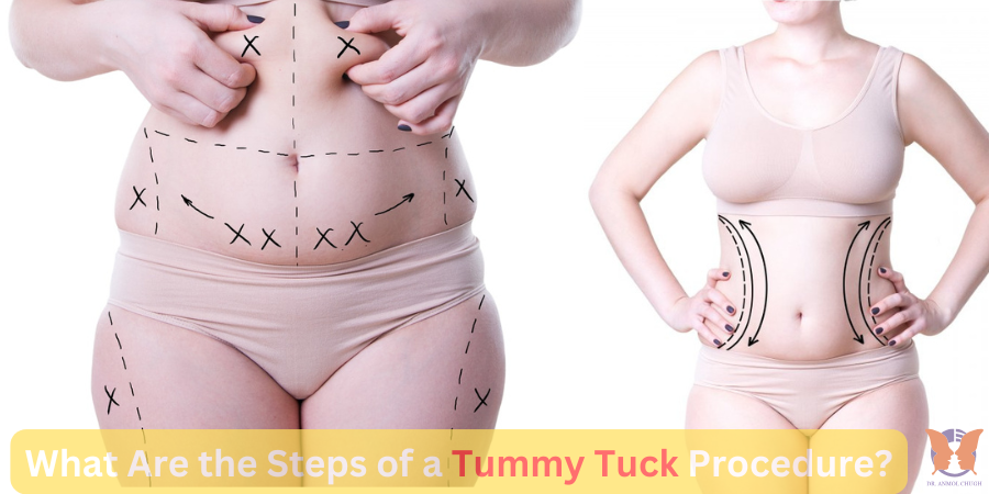 Steps of a tummy tuck procedure – From consultation to recovery